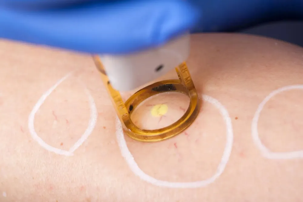 Laser endoveineux et Laser vasculaire